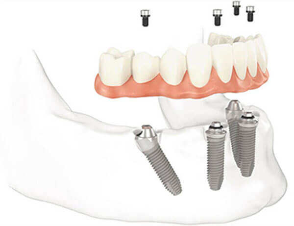 Full Mouth Restoration Lower