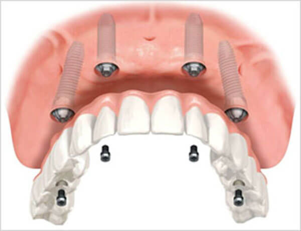 Full Mouth Restoration Upper