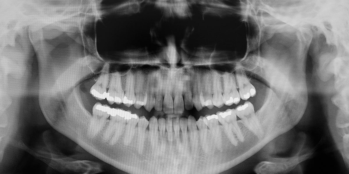 Dental X-Ray