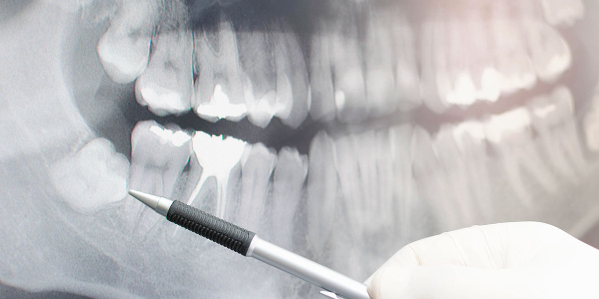 Wisdom Tooth X-Ray